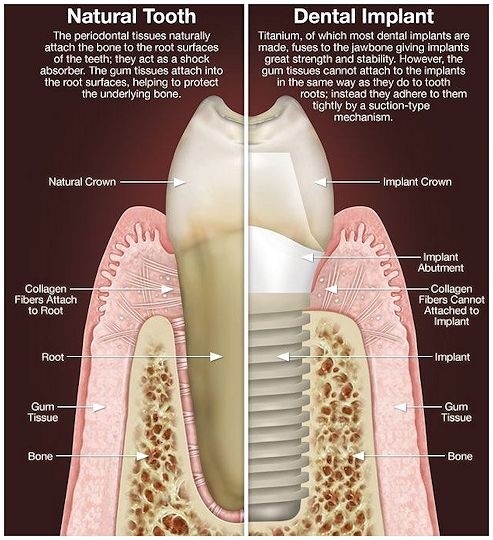 why dental implants